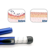 Magic Wrinkle Care Pen – Facial Line Lifter with Sterile Cartridge for Tear Trough & Anti-Aging Treatment