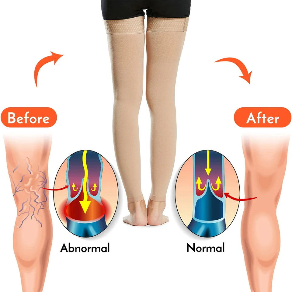 1 Pair Open Toe Thigh High Compression Stockings with Silicone Band – 20-30mmHg Graduated Support for Varicose Veins