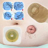 Open Clip Ostomy Bags – Two-Piece Drainable Colostomy & Ileostomy Pouches with Hoop & Loop Closure for Stoma Care