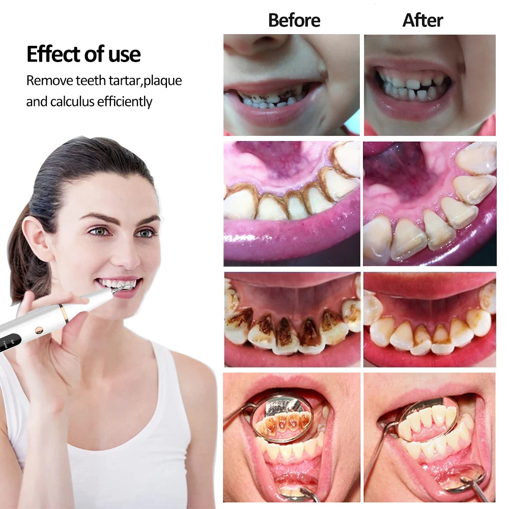 Ultrasonic Dental Calculus Scaler – Electric Tartar & Plaque Remover for Teeth Cleaning and Stain Elimination