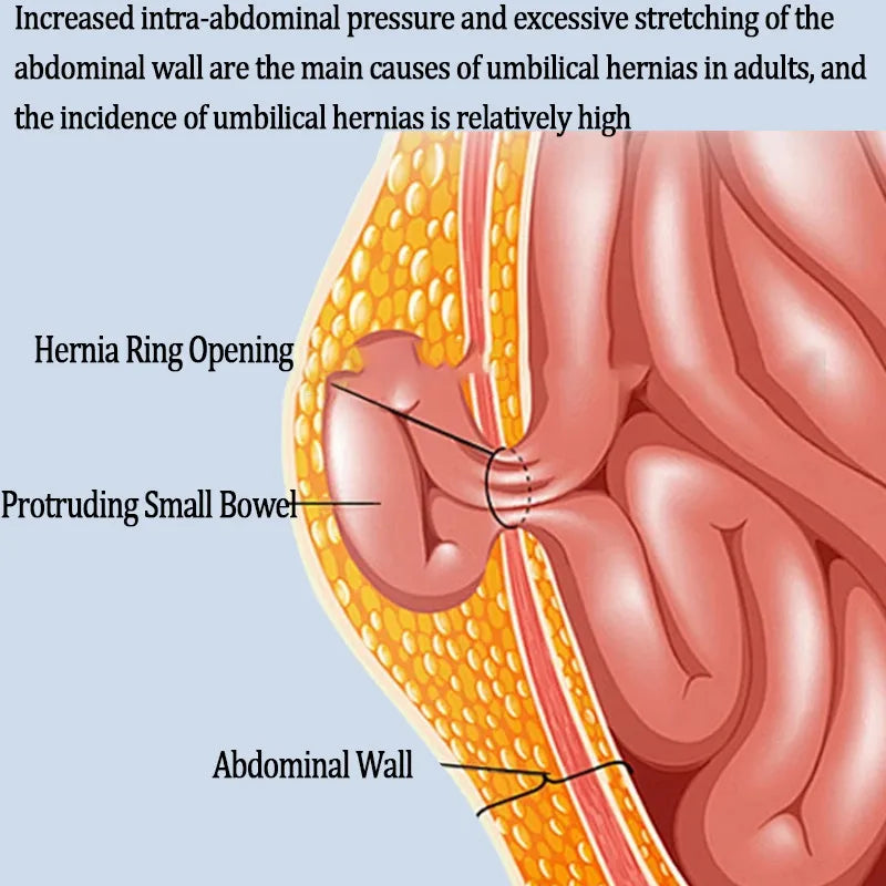 3 Sizes Breathable Umbilical Hernia Support Belt – Adult Abdominal Compression with Postpartum Hernia Pad
