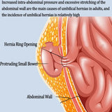 3 Sizes Breathable Umbilical Hernia Support Belt – Adult Abdominal Compression with Postpartum Hernia Pad